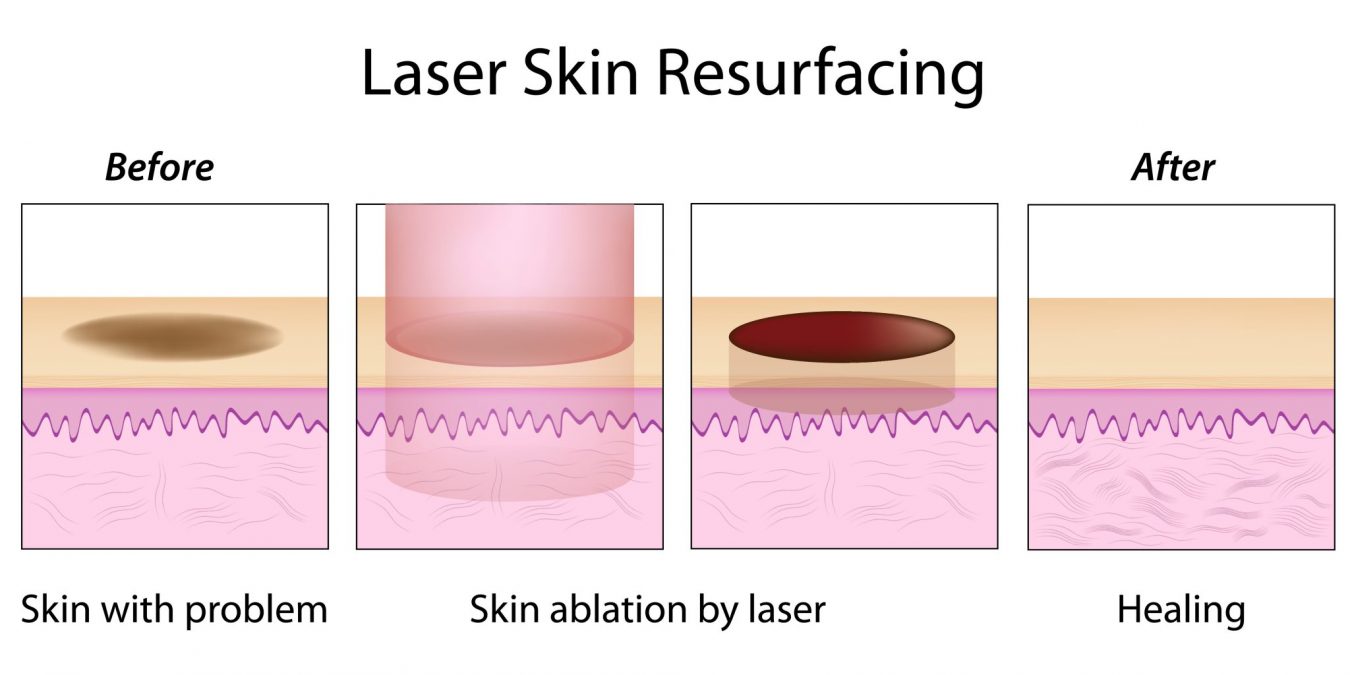 Laser Skin Resurfacing - AnewSkin Aesthetic Clinic And Medical Spa D.C