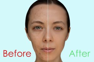 BeforeAfter Chemical peel treatment for acne