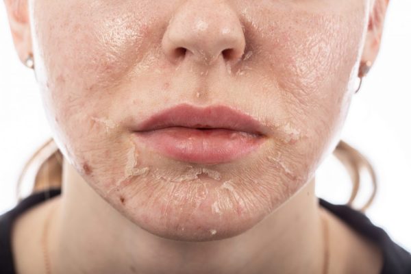 Image of peeling skin after a chemical peel