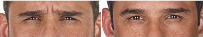 BeforeAfter xeomin injection to frown lines