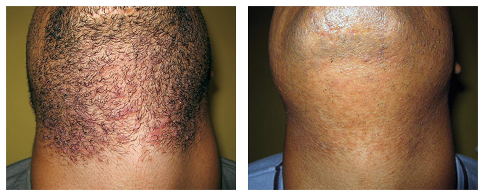 Laser hair removal before/after