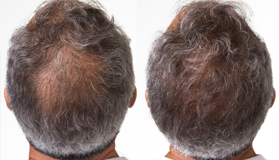 Before/After Hair Restoration treatment