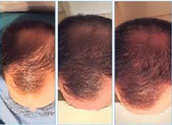 Before/After Hair Restoration treatment