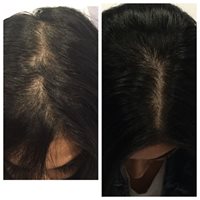 Before/After Hair Restoration treatment