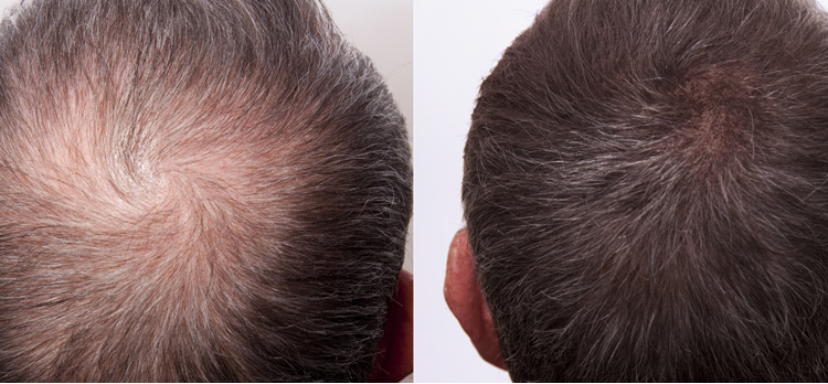 Before/After Hair Restoration treatment