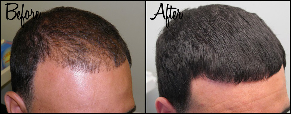 Before/After Hair Restoration treatment