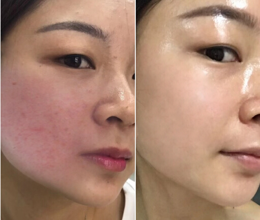 BeforeAfter IPL photofacial