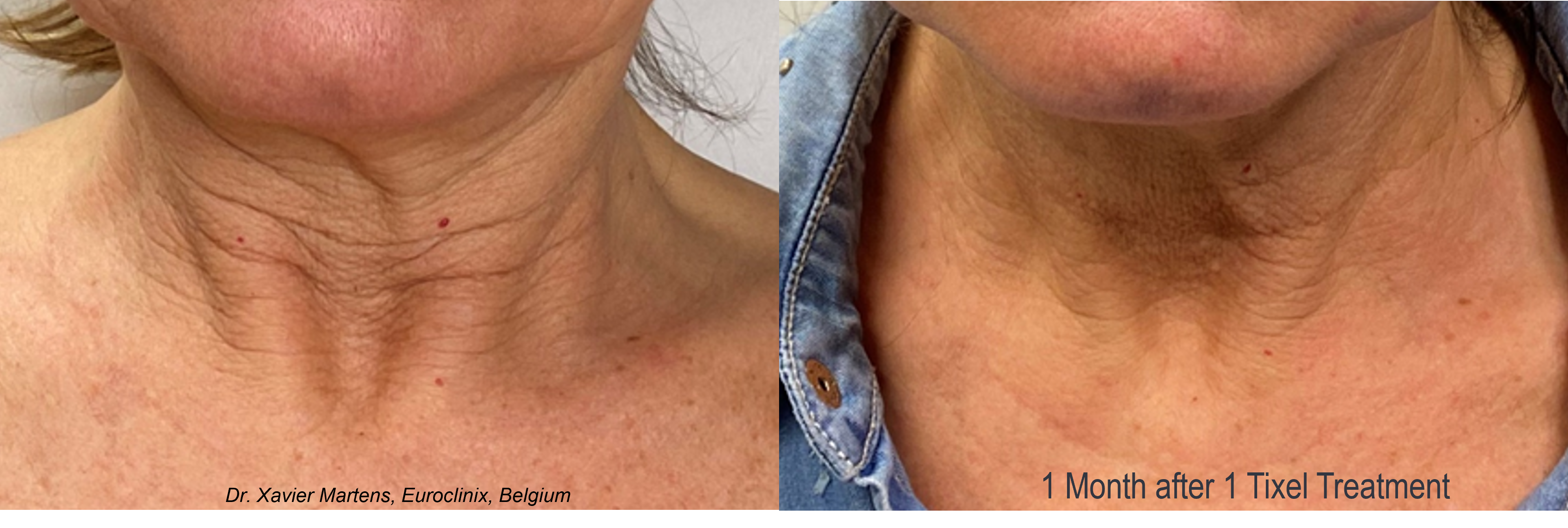 TIXEL NON-INVASIVE SKIN REJUVENATION - AnewSkin Aesthetic Clinic And ...