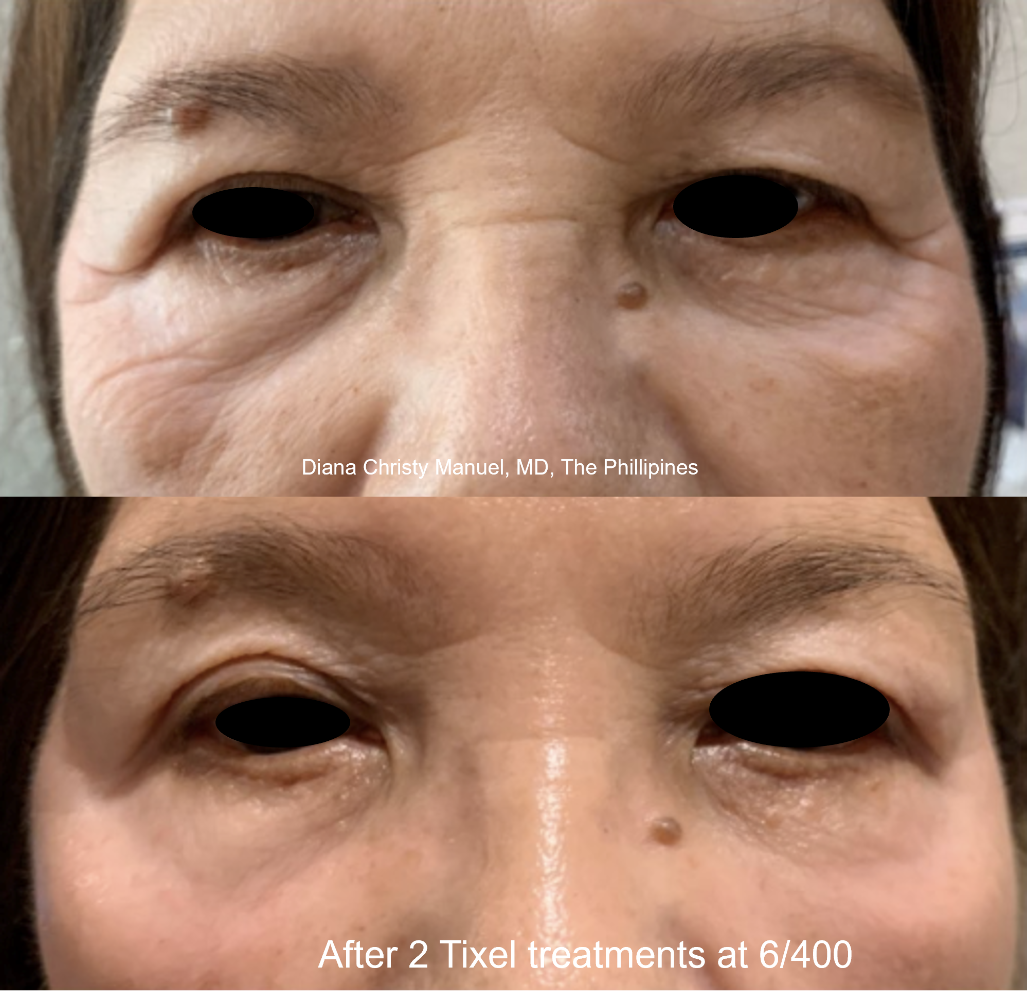 TIXEL NON-INVASIVE SKIN REJUVENATION - AnewSkin Aesthetic Clinic And ...