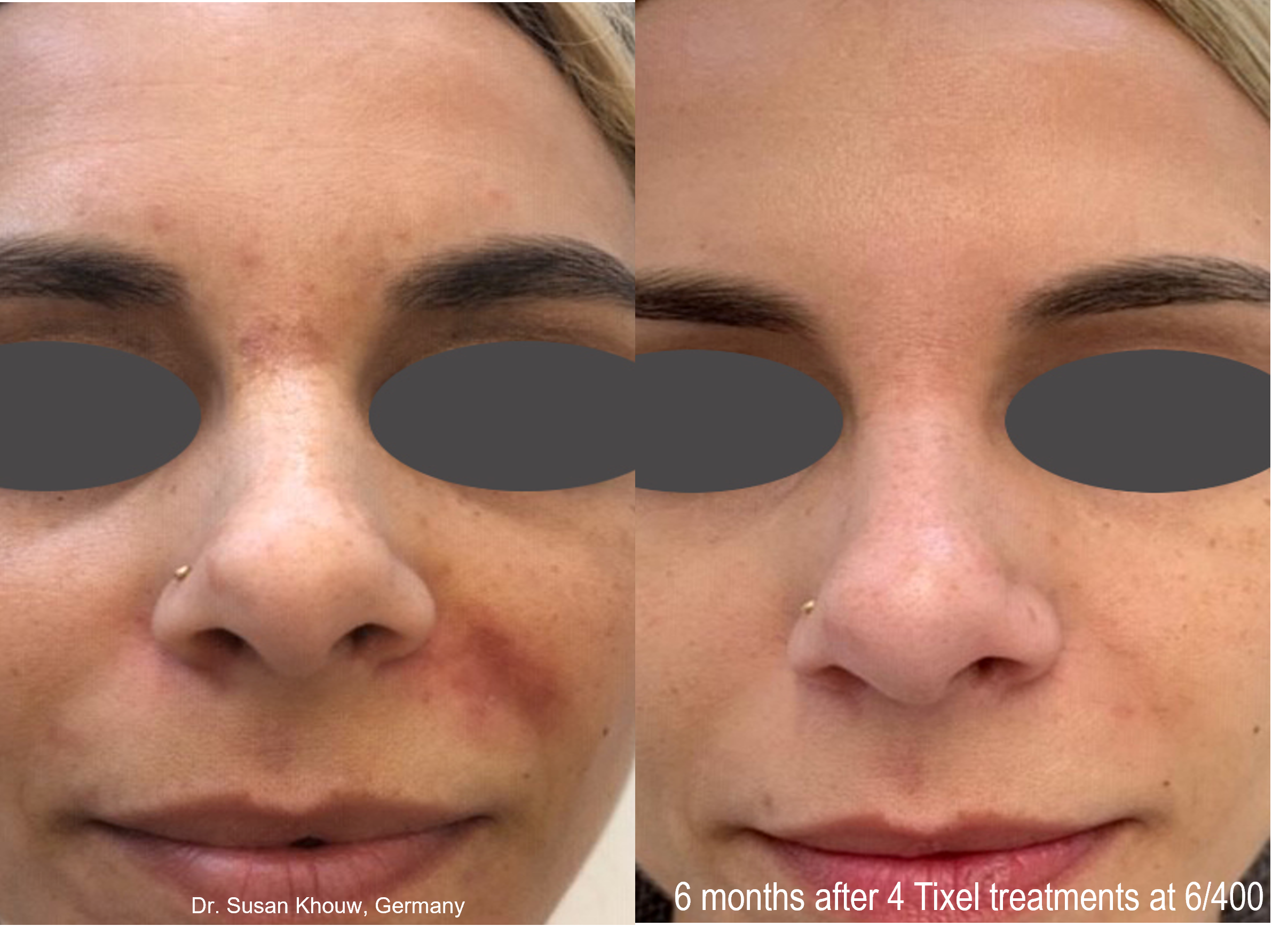 TIXEL NON-INVASIVE SKIN REJUVENATION - AnewSkin Aesthetic Clinic And ...